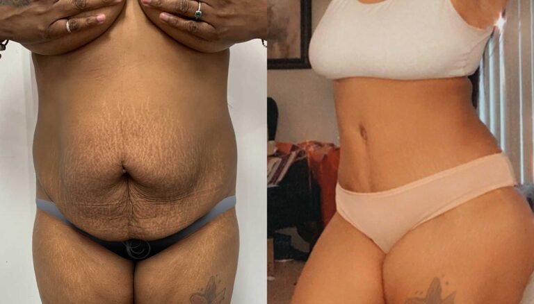 Before-and-after-2023-TUMMY-TUCK-02-768x438