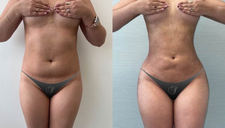 Lipo-360-Before-After_01-768x438