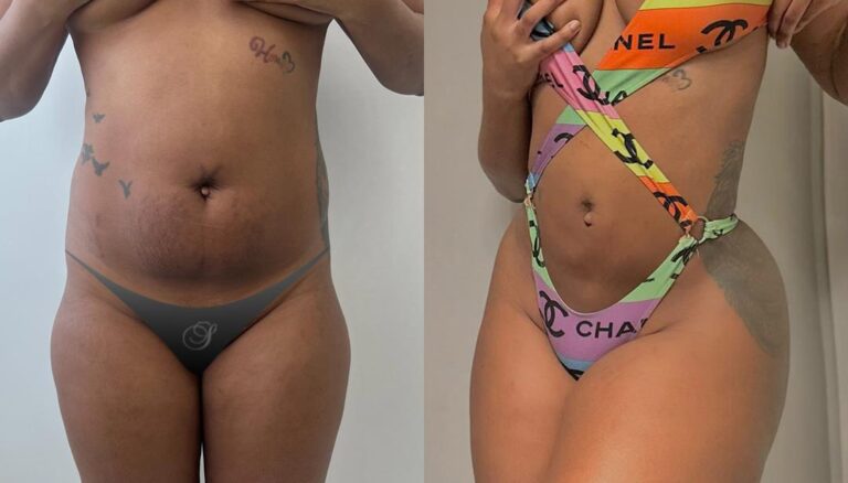 Lipo-360-Before-After_02-768x438 (2)